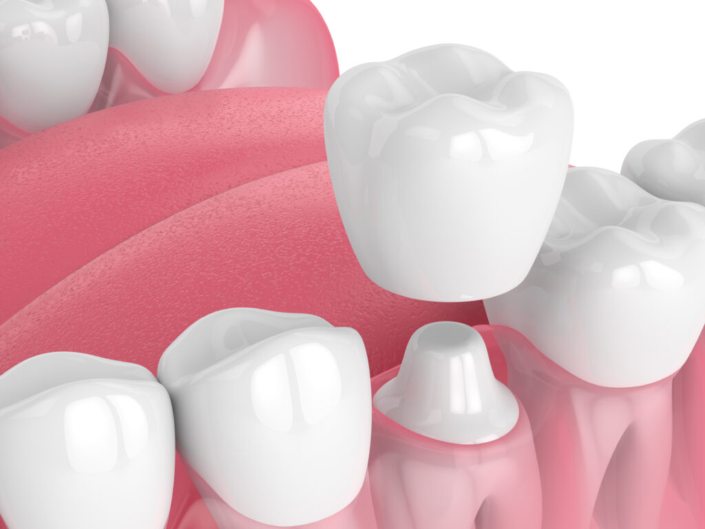 Dental Crowns crown dentist fletcher nc