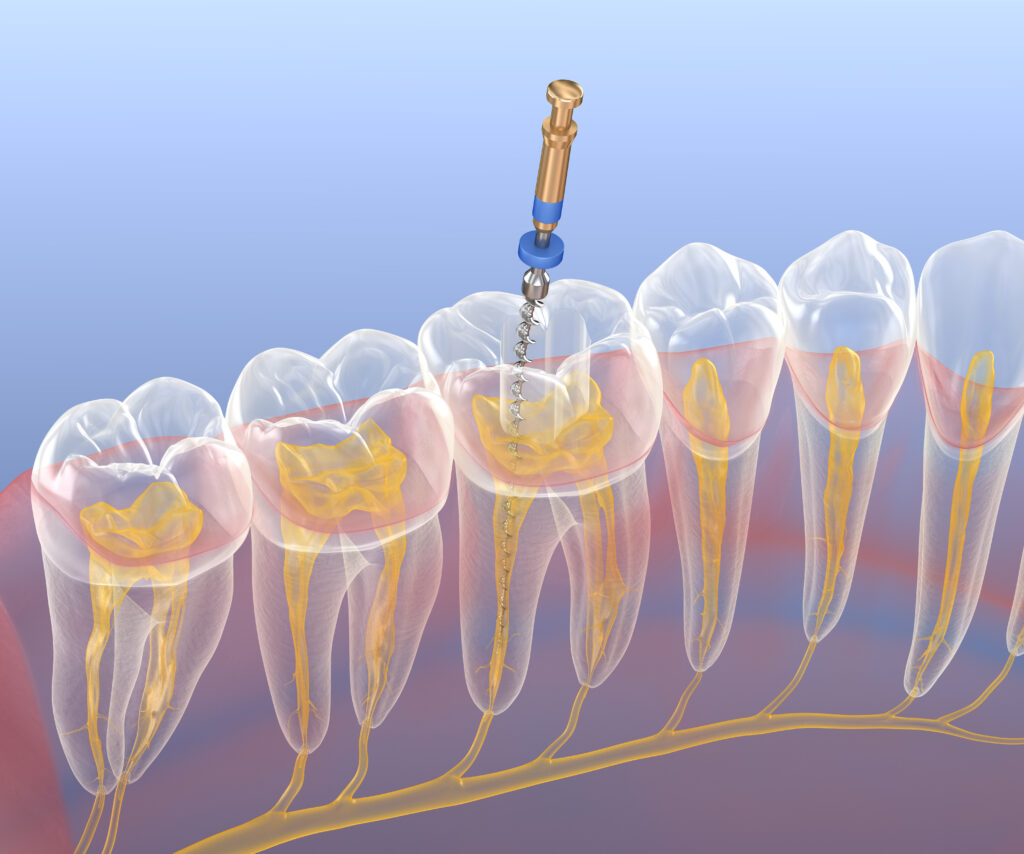 root canals dentist fletcher north carolina