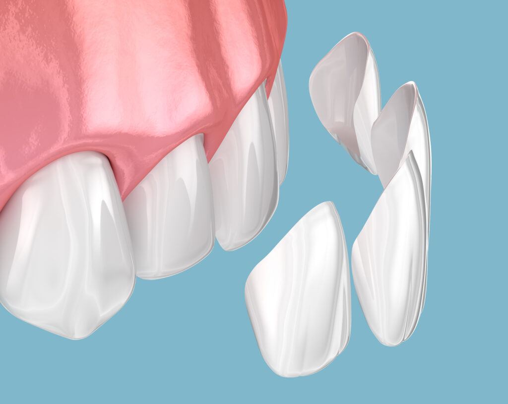 veneers cost fletcher nc