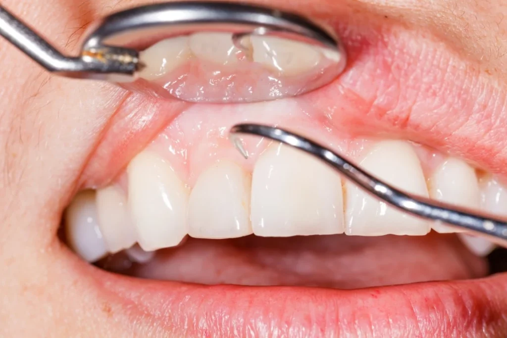 Bleeding Gums - Fletcher, NC