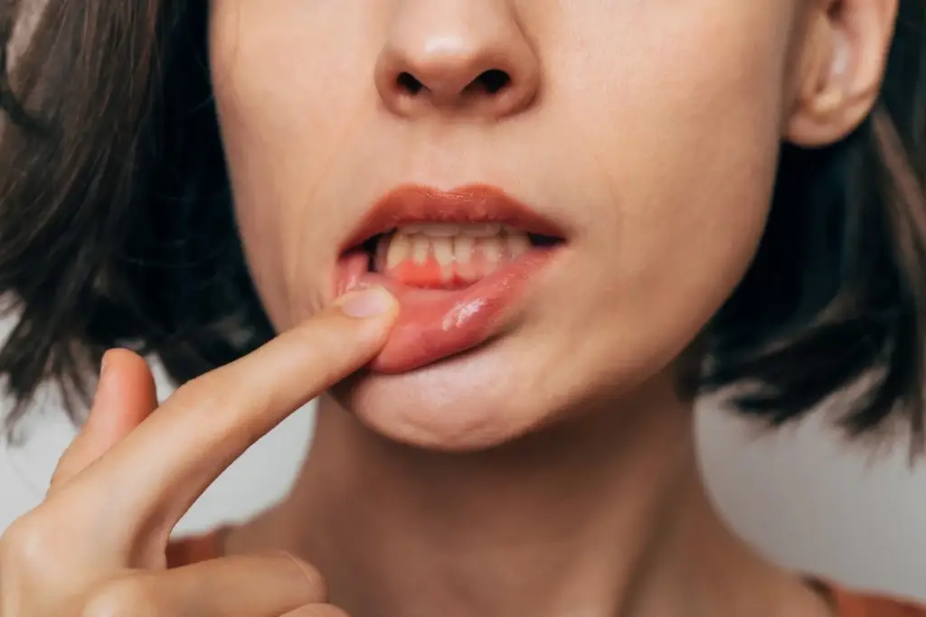 Gum Disease - Fletcher, NC